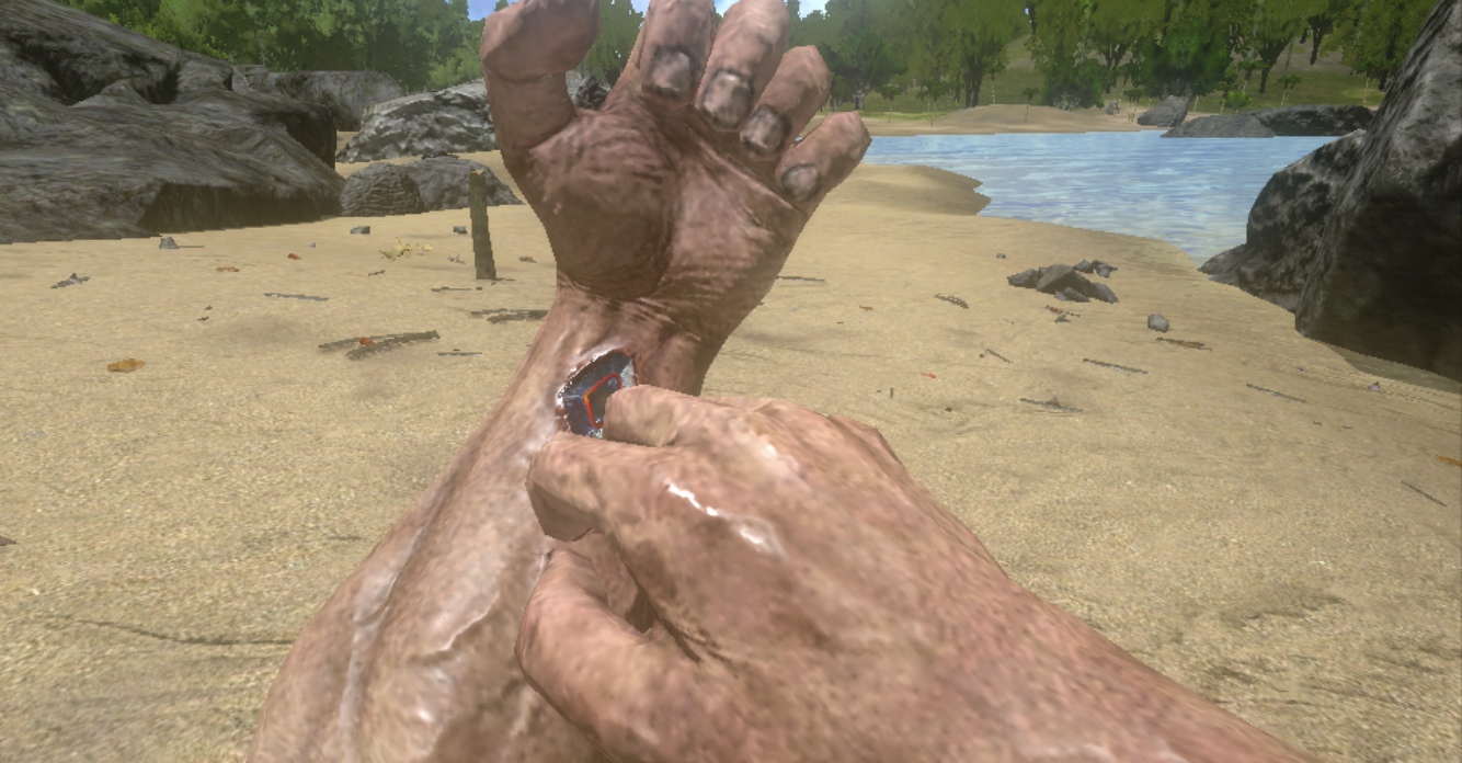 injured hand on beach