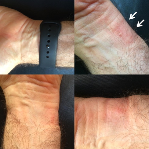 wrist with watch marks